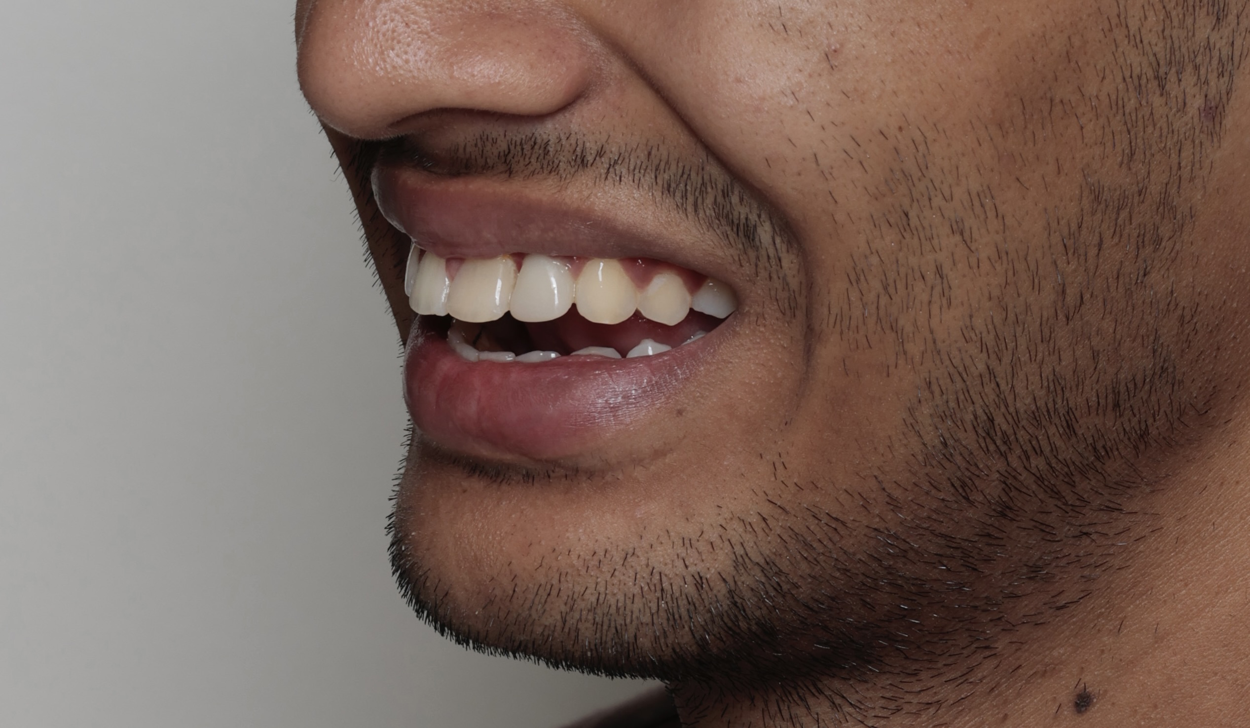 Bone Augmentation for Dental Implants